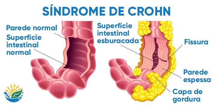 O que crohn autoimune sintomas causas tem cura